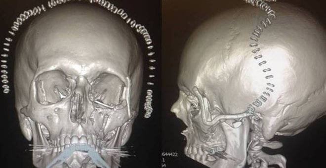 H πρώτη 3D εκτύπωση προσώπου είναι πλέον γεγονός !